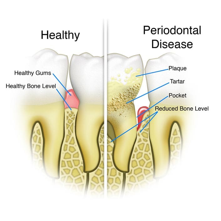 Gum Treatments - Dental Services